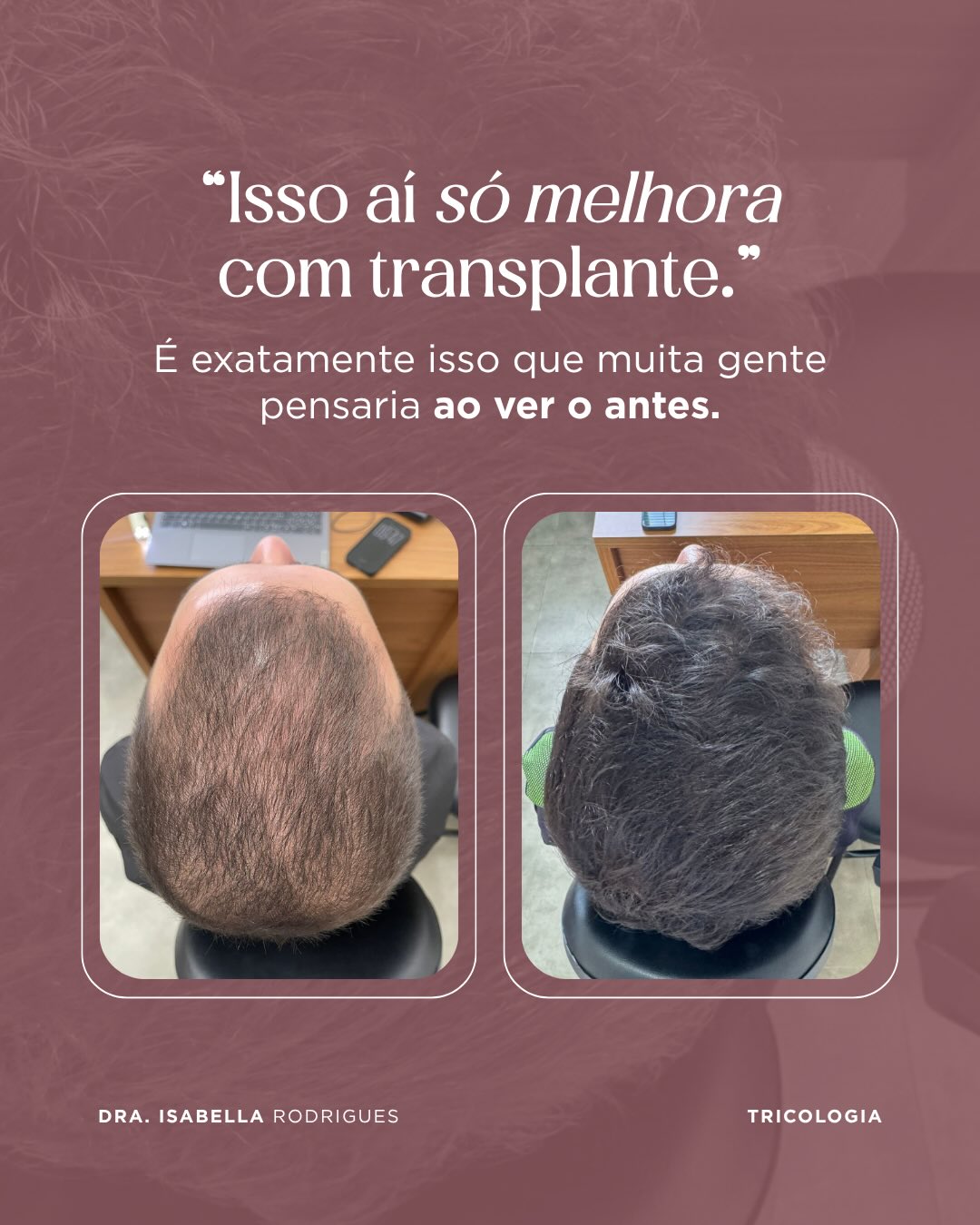 Antes e depois — recuperação de densidade no topo da cabeça sem transplante