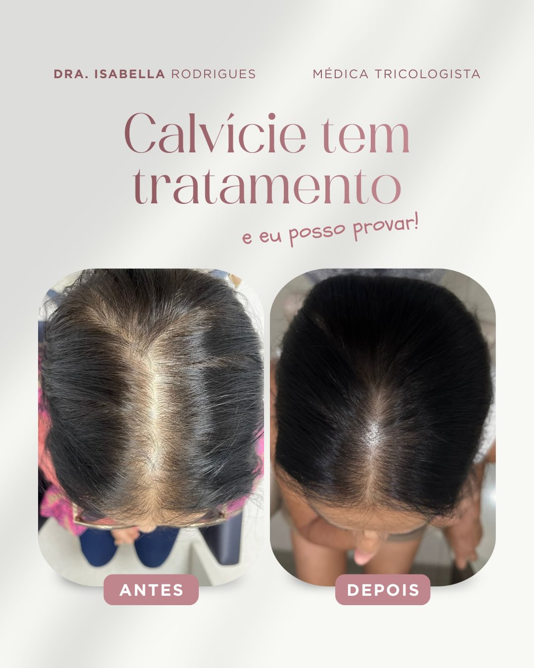 Antes e depois — preenchimento da linha central em calvície feminina