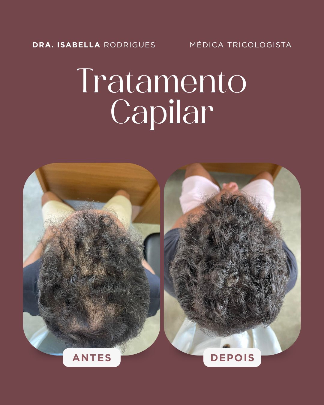 Antes e depois — recuperação de densidade no topo da cabeça em tratamento capilar masculino