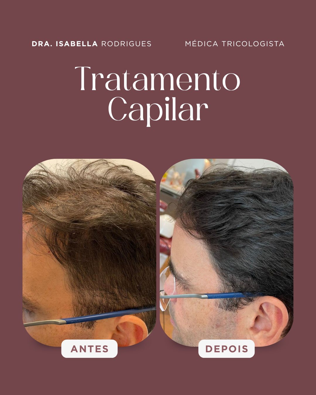 Antes e depois — linha frontal masculina mais densa após tratamento clínico