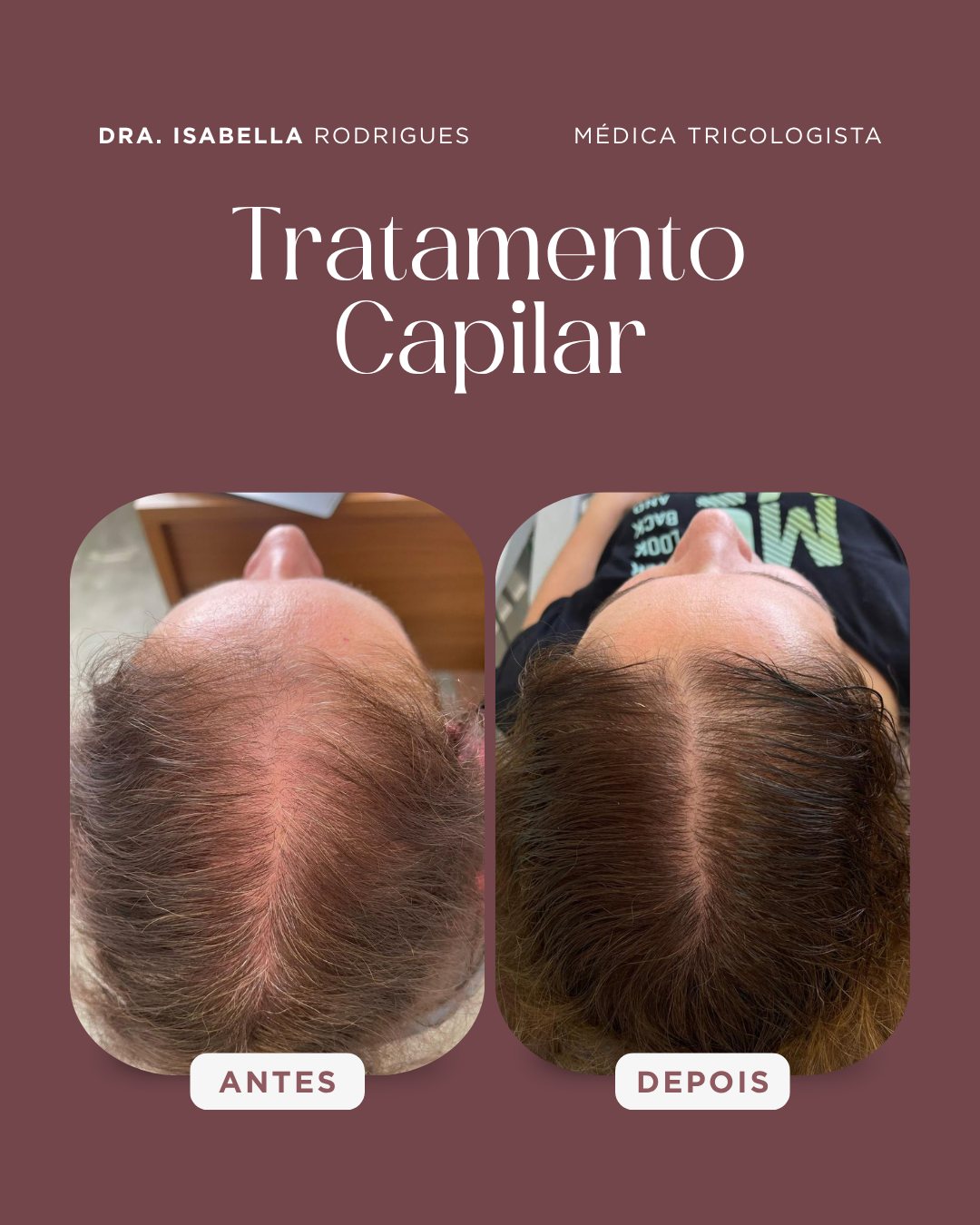 Antes e depois — mais densidade na linha central em tratamento capilar feminino