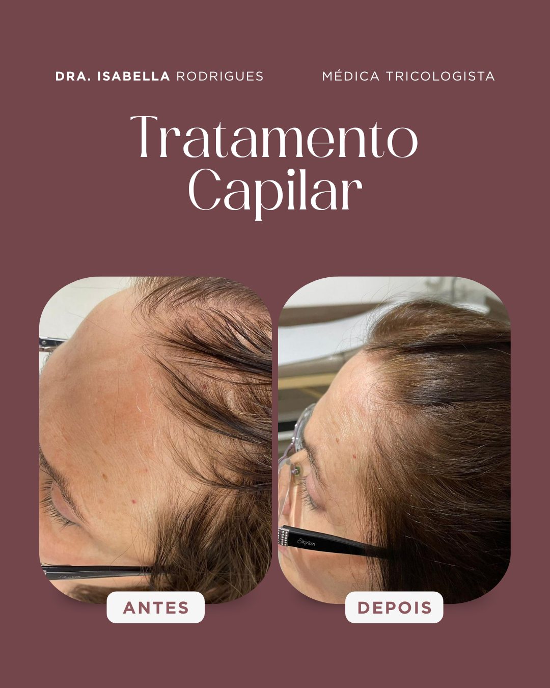 Antes e depois — entradas e afinamento frontal feminino tratados clinicamente