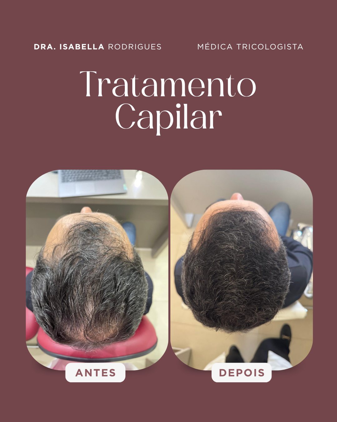 Antes e depois — coroa preenchida em tratamento capilar sem transplante